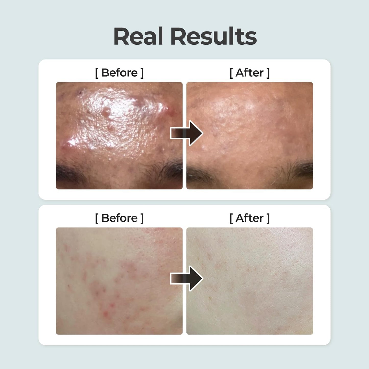 numbuzin No.1 Pure-Full Calming Herb Toner | Acne-Prone Skin, Centella Asiatica, Deep Calming, 10.14 fl oz
