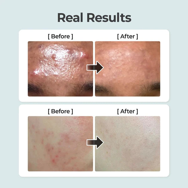 Anua Heartleaf 77% Soothing Toner: Pure Calm! 4 Anua Heartleaf 77% Soothing Toner: Pure Calm!