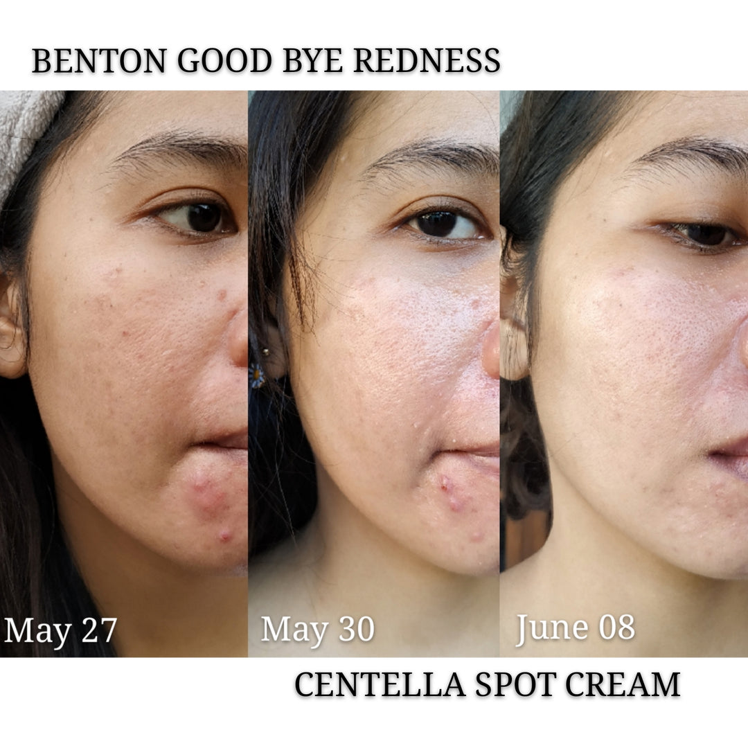 [BENTON] Good bye Redness Centella Cica Spot Cream
